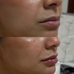 Preenchimento Labial: Procedimento realizado para proporcionar mais definição, hidratação e equilíbrio aos lábios, preservando a naturalidade e a proporção facial, de acordo com os objetivos de cada paciente.