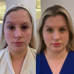 Protocolo de Rejuvenescimento Facial: Um tratamento personalizado que combina técnicas para suavizar os sinais do envelhecimento, restaurar a harmonia facial e valorizar a beleza natural, respeitando as características únicas de cada paciente.